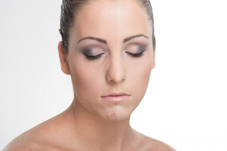 Eat Your Heart Out, Pregnancy Pigmentation! SPA+CLINIC