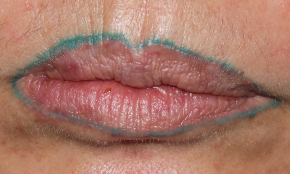 Dermatologist Warns Of Cosmetic Tattoo Dangers