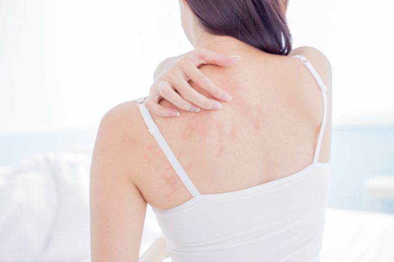 eczema support